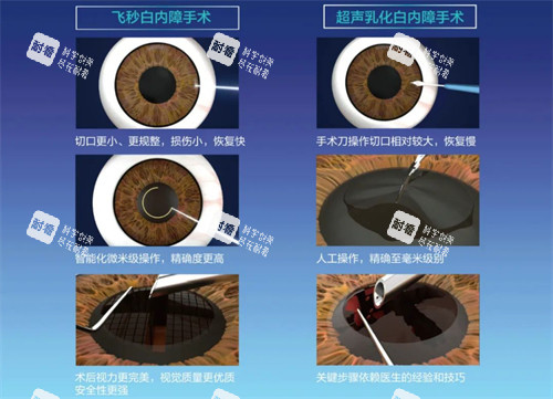 飞秒白内障手术过程图 飞秒白内障手术过程图
