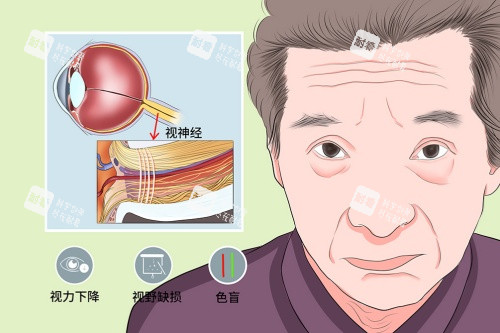 视神经萎缩症状卡通图 视神经萎缩症状卡通图