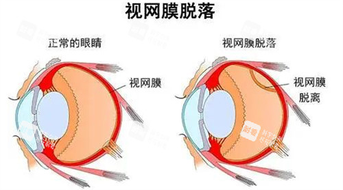 视网膜脱落和正常眼睛对比 视网膜脱落和正常眼睛对比