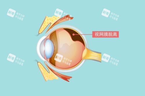 视网膜脱落图片展示 视网膜脱落图片展示