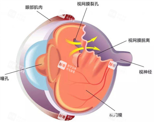 视网膜脱落展示图 视网膜脱落展示图
