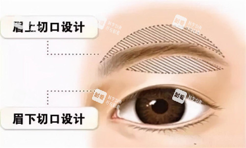 提眉手术切口动画演示图 提眉手术切口动画演示图