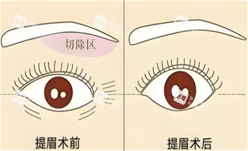 提眉手术前后对比 提眉手术前后对比