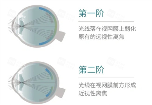 思问子夏离焦眼镜矫正过程