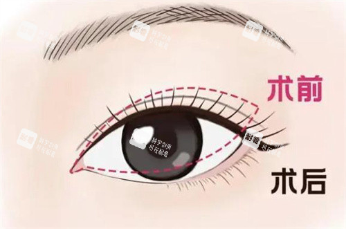双眼皮修复手术对比 双眼皮修复手术对比