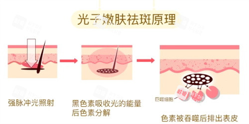光子嫩肤的祛斑原理 光子嫩肤的祛斑原理