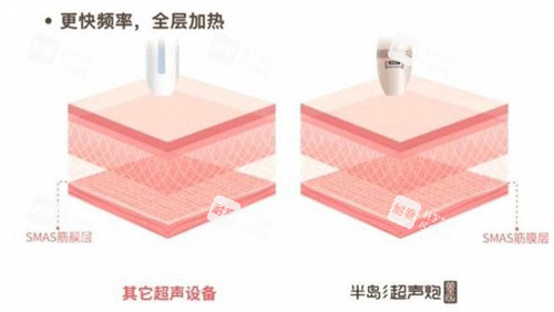 半岛超声炮和普通超声