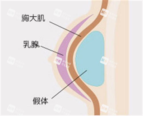 隆胸示意图