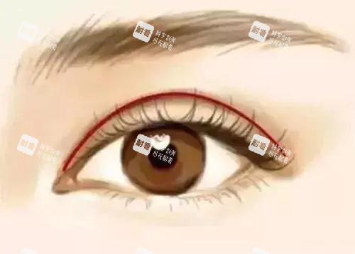 新月形双眼皮.webp 新月形双眼皮.webp