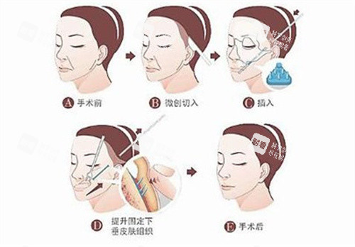 筋膜悬吊手术过程 筋膜悬吊手术过程