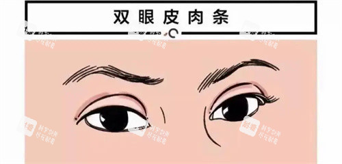 双眼皮肉条痕图 双眼皮肉条痕图