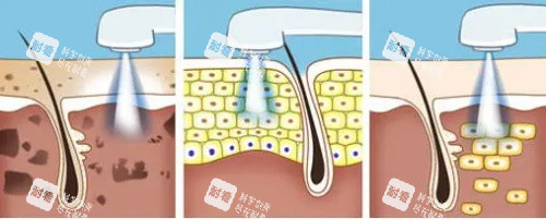 光子嫩肤的过程 光子嫩肤的过程