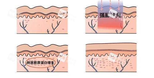 光子嫩肤的祛斑过程 光子嫩肤的祛斑过程