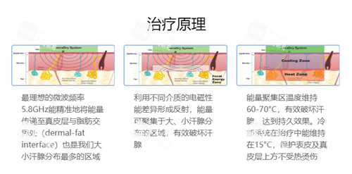 清新微波去腋臭技术原理图解 清新微波去腋臭技术原理图解
