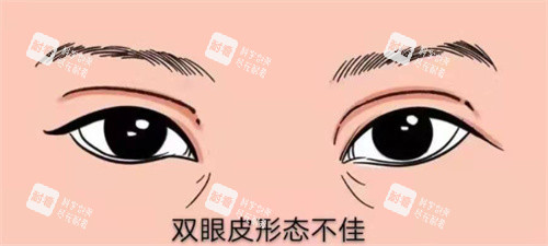 双眼皮修复示图 双眼皮修复示图