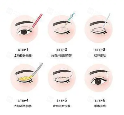 全切双眼皮流程图示 全切双眼皮流程图示