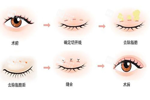 切开式双眼皮过程 切开式双眼皮过程