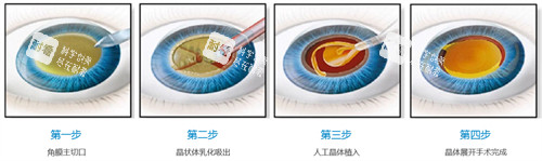 超声乳化白内障手术流程图