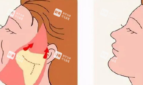 拉皮手术的术后对比图 拉皮手术的术后对比图