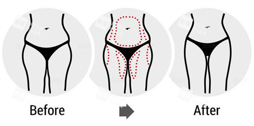 腰腹大腿吸脂前后对比图 腰腹大腿吸脂前后对比图
