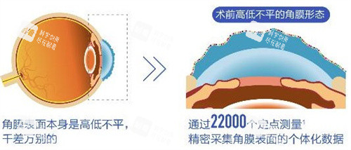 个性化飞秒术前 个性化飞秒术前