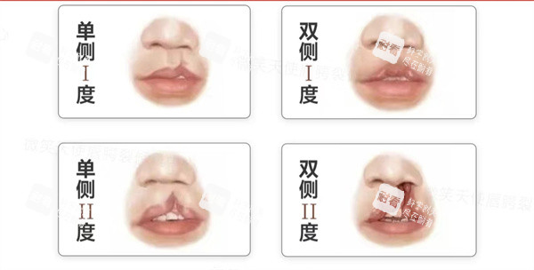 唇裂