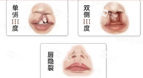 唇裂分型