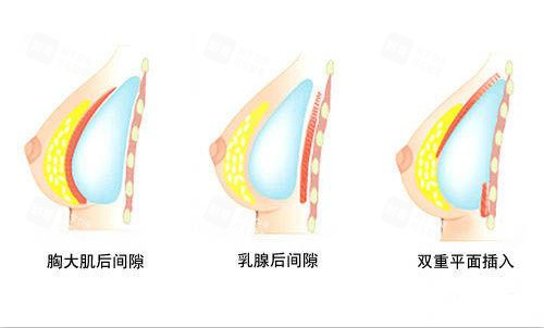 隆胸假体植入方式示意图 隆胸假体植入方式示意图