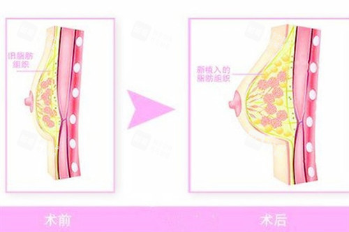 自体脂肪隆胸图片 自体脂肪隆胸图片