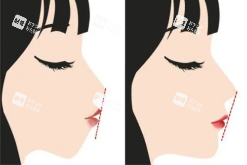 正颌手术前后的对比图
