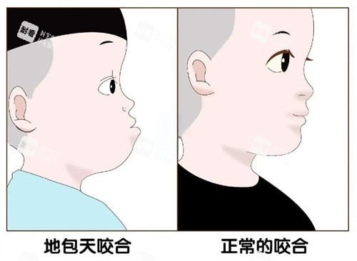 地包天和正常对比图 地包天和正常对比图
