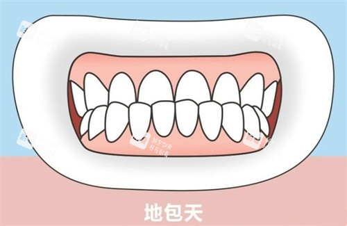 地包天示意图 地包天示意图