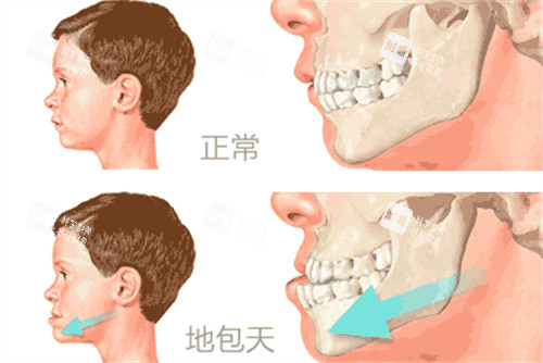 地包天与正常咬合对比动画图 地包天与正常咬合对比动画图