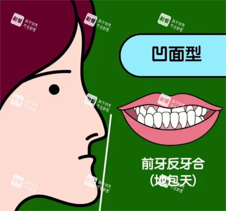 地包天漫画示意图 地包天漫画示意图