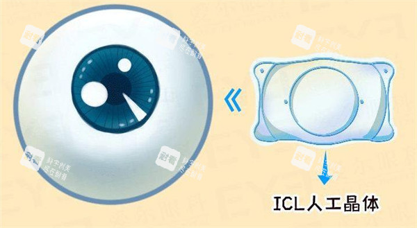ICL人工晶体图示 ICL人工晶体图示