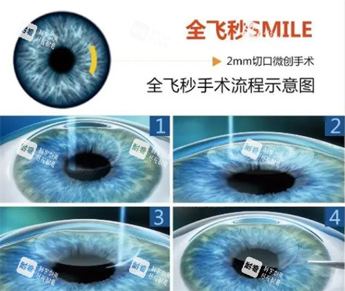 全飞秒近视手术流程图 全飞秒近视手术流程图