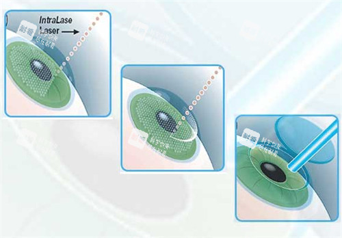 近视手术过程图解 近视手术过程图解