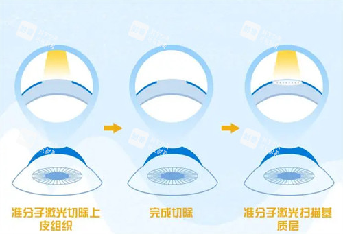 不同的近视手术 不同的近视手术