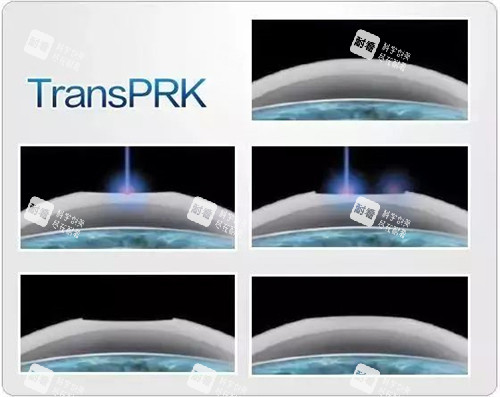 TPRK近视手术示意图
