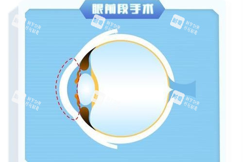 眼前段近视手术示意图 眼前段近视手术示意图
