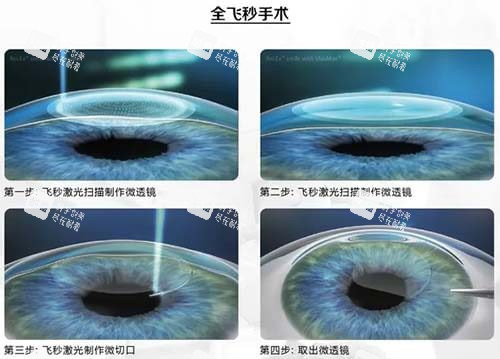近视眼手术4 近视眼手术4