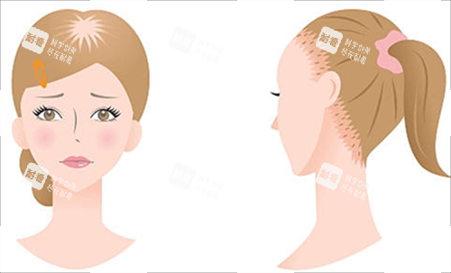 女生脱发类型