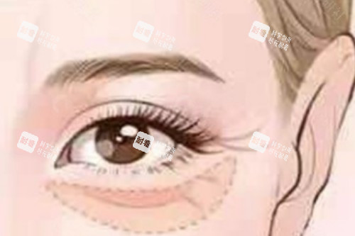 眼袋整形卡通图 眼袋整形卡通图