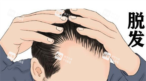 发际线后移