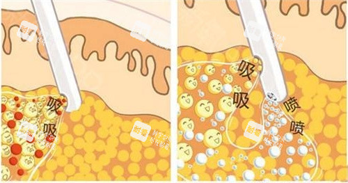 抽脂手术抽脂方式动画演示图