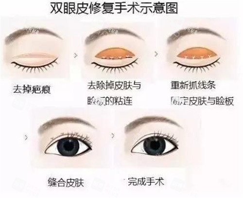 双眼皮修复示意图 双眼皮修复示意图