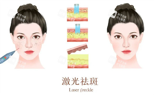 激光祛斑前后 激光祛斑前后