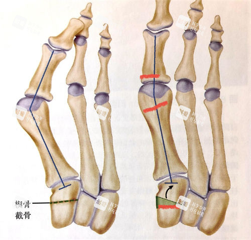 拇外翻传统手术动画展示图