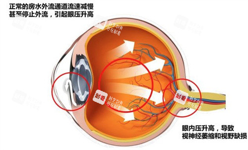 什么是急性闭角型青光眼
