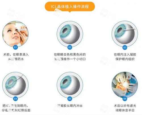 ICL晶体植入手术流程 ICL晶体植入手术流程